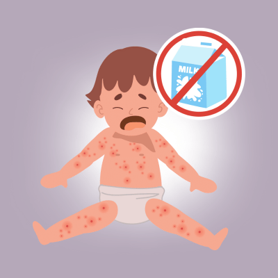Alergia à Proteína do Leite de Vaca (APLV): Quando Procurar um Gastropediatra?